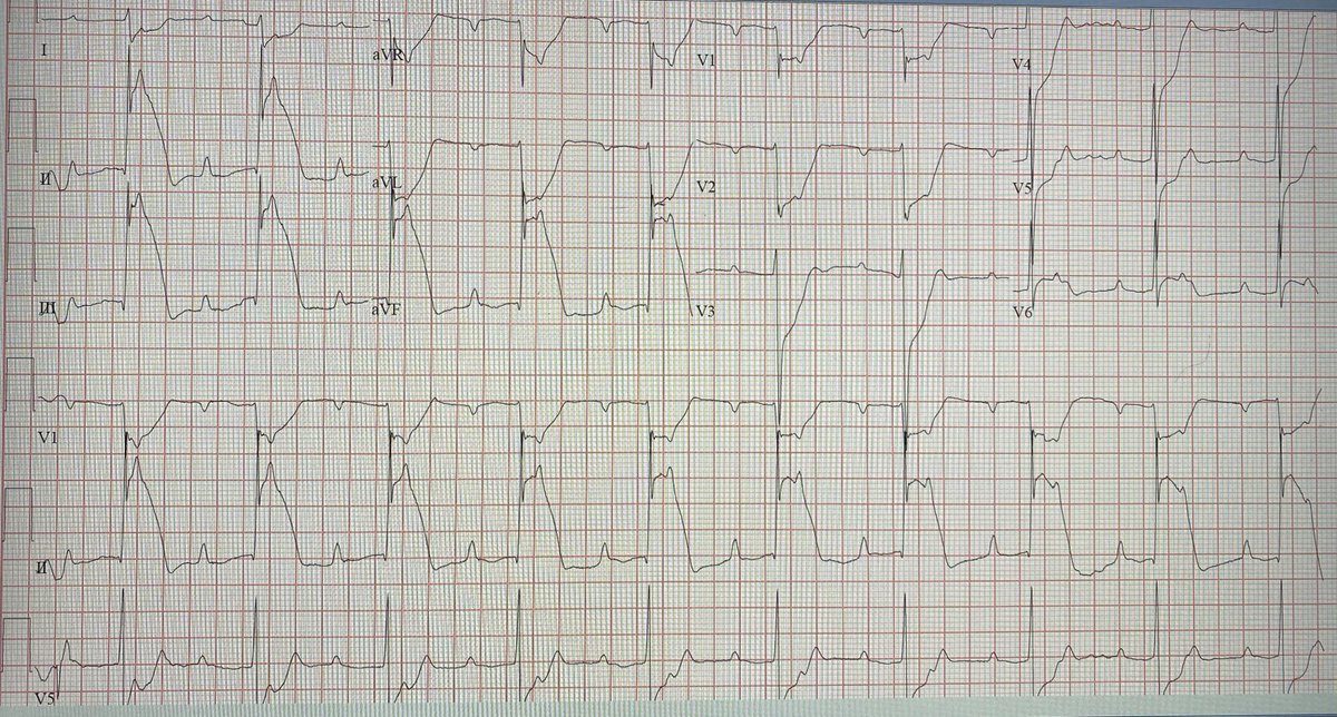 TTelila's tweet photo. 50s, on the OR table for incarcerated  hernia, bowel reduced but incision not closed yet, PEA, CPRx2, ROSC, BP 80s/60s on pressors —surgeon asks 4 help? 🤷🏾‍♂️
⁦@ShariqShamimMD⁩ 
⁦@MusaSharkawiMD⁩ 
⁦@evandrofilhobr⁩ ⁦@chadialraies⁩ ⁦
#ACFIT #cardiotwitter https://t.co/wIysKQzviI