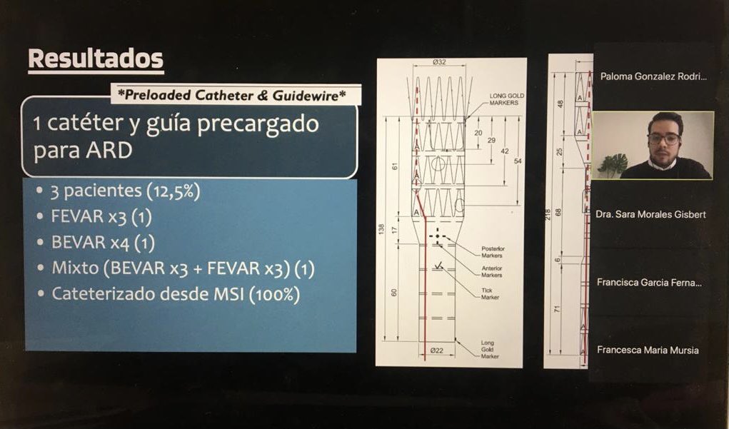 Enhorabuena al Dr. José Ignacio Chiriboga Granja <a href="/josechiribogamd/">José Ignacio Chiriboga</a> nuestro residente de 5 año de <a href="/CVA_DrPeset/">CVADrPeset</a> del <a href="/GVADrPeset/">DS Doctor Peset</a> por la excelente presentación y por obtener el premio al mejor caso clínico otorgado en el  congreso de la <a href="/svacv_vascular/">SVACV_vascular</a>