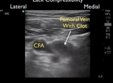 Kumaranism's tweet photo. #POCUS is such a simple and useful tool in the early recognition of blood clot and starting early anticoagulation. #COVID #MedEd https://t.co/X4IvzlK15W