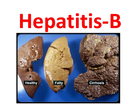 HEPATITIS B30m infected annually globally through sex, needles, bodily fluids, mum-to-baby (4/1000 UK).2 bn have been people infected, most get over it but can be chronically infectedCan be asymptomatic or can get jaundice, fatigue, nausea, hepatic cancer1% fatality rate9/