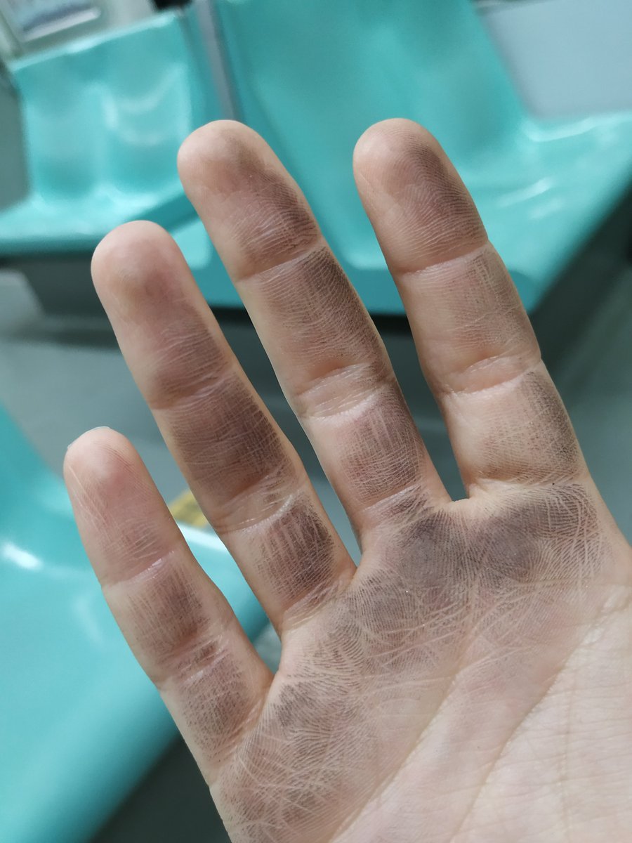 Metro istasyonlarının dezenfekte edildiğinden emin miyiz <a href="/istanbulbld/">İstanbul Büyükşehir Belediyesi</a> <a href="/ekrem_imamoglu/">Ekrem İmamoğlu</a> <a href="/drfahrettinkoca/">Dr. Fahrettin Koca</a>
 ? Sabit merdivenlerin korkulukları aylardır temizlenmiyor gibi her kullandığımda aynı. Fotoğraf bugünden, M6 Levent istasyonu. #hijyen #pandemi #corona #yeninormal ?? #istanbul