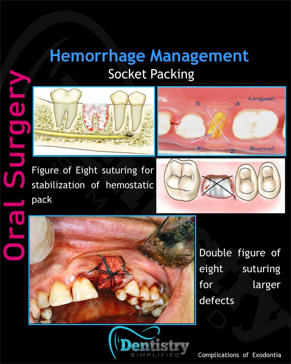 Dent_Simplified's tweet photo. Hemorrhage management: Socket packing technique

#Dentistrty #Oral_Health #mds #dds #mdsprep  #mdspreparation  #next_exam #bds  #dental #dentistry #dentists #dentalstudent #dentalcare #nbe #neet_dental #Endodontics #Endo #oralmedicine #medicine #oralsurgery #OMFS #nbde https://t.co/ebaXzfLmyx
