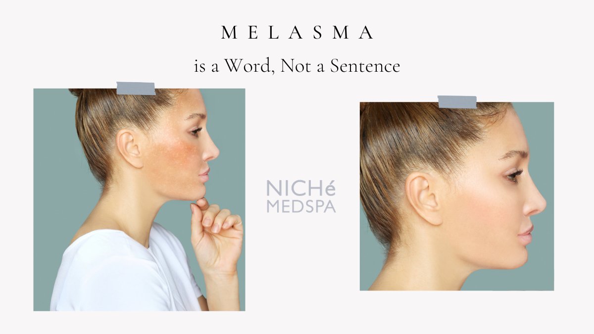 NicheMedSpa's tweet photo. What do you need to know about #MELASMA?

Melasma aka #chloasma. If you know exactly what we are talking about you either A - have a deep knowledge in #dermatology or B - you have it. Is there actually a solution for this?! Find out following link below.

https://t.co/nXKWWVzTJT https://t.co/gFpNTYeFai