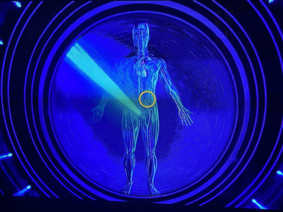 busterknighty69's tweet image. #5goldrings 
Locate where you would have a #Splenectomy ?
I’ve no idea - and I’m embarrassed to say I’ve had a Splenectomy 🥴
I swapped it for #Claudiawinklemans hair