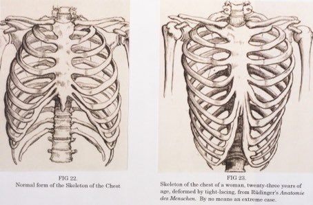 Long term tight lacing, especially when the bones were still developing, could led to the rib cage becoming deformed.  https://www.rcseng.ac.uk/library-and-publications/library/blog/effects-of-the-corset/