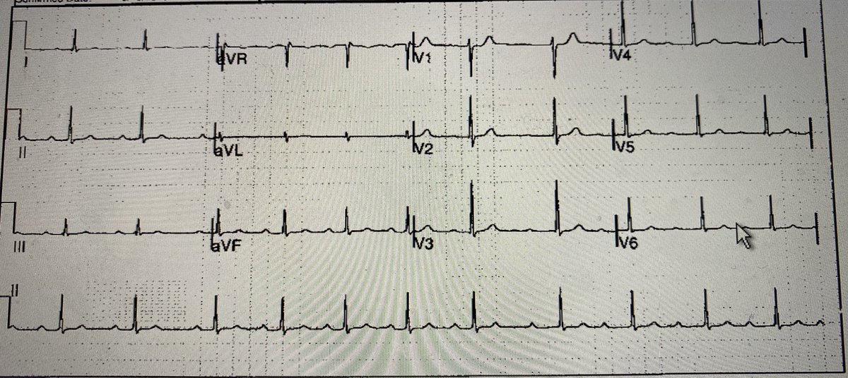 rspenz's tweet photo. Reported as AF by a pathology company #ECGFAIL https://t.co/8VUfvvkN8Z