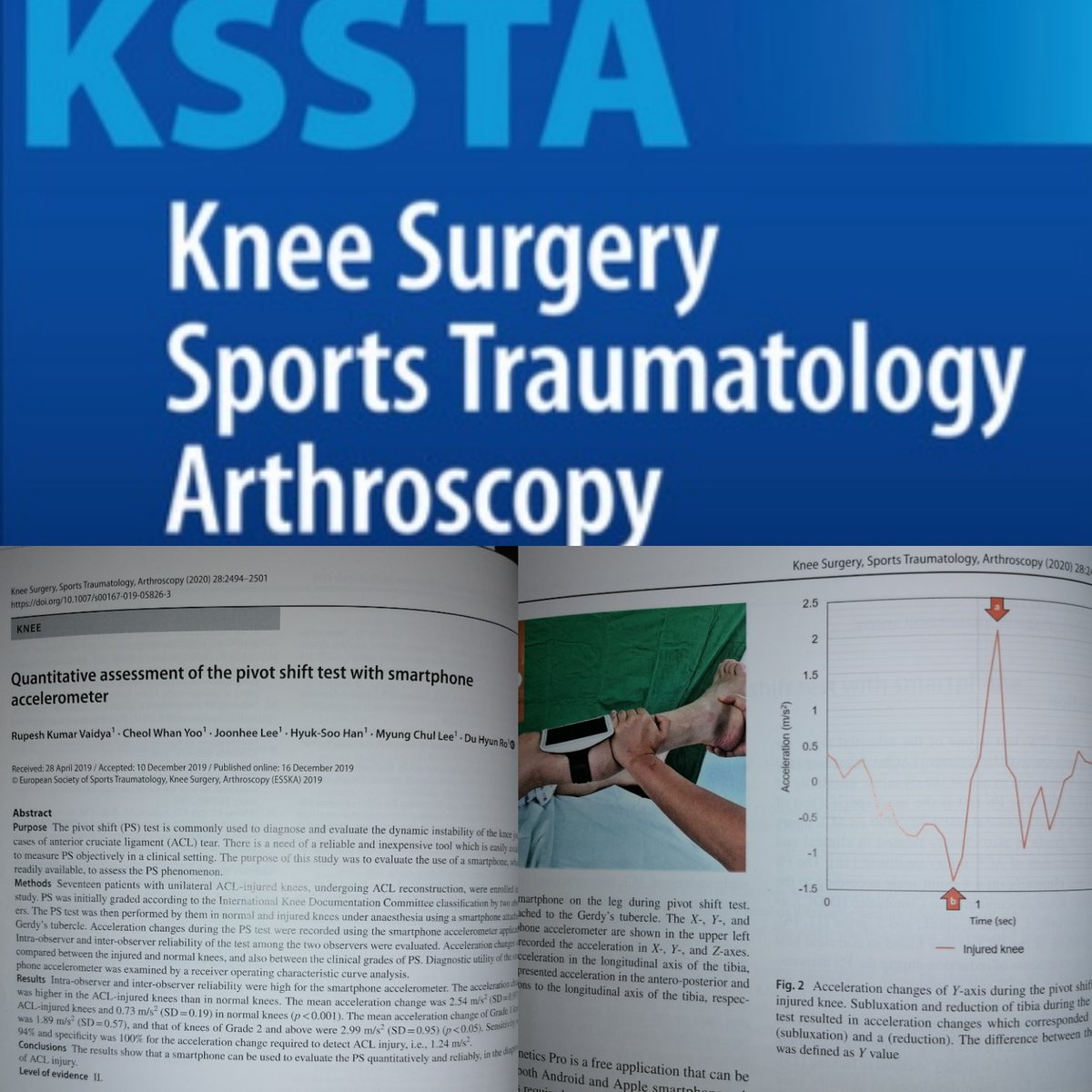 DrAlentornGeli's tweet image. @KSSTA article of the week:
👉Quantitative assessment of the #pivotshift phenomenon with #smartphone
👉Great option for an objective measurement of the rotational instability in #ACL tears.
👉Thanks Drs. Vaidya, Yoo, Lee, Han, Lee, and Ro.
#sportsmedicine
#knee
#kneesurgery