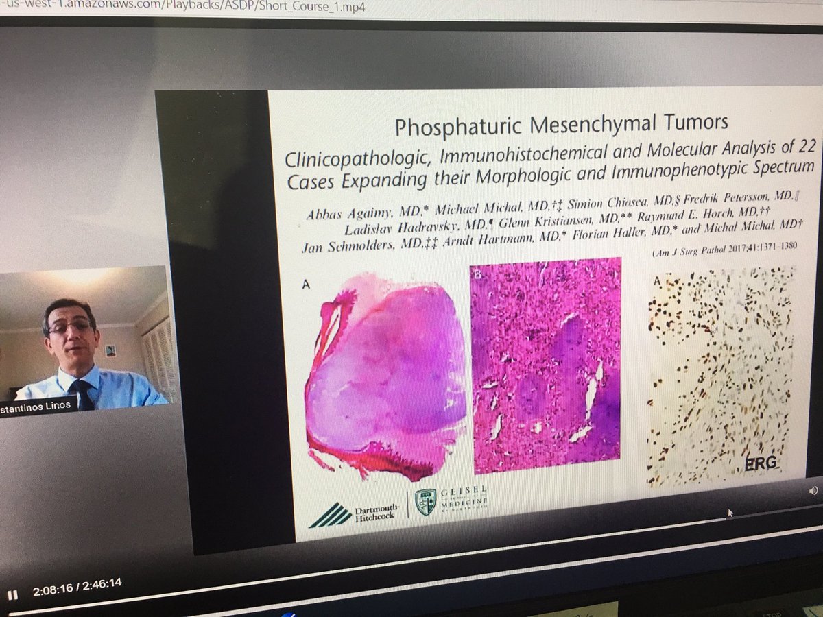 GregHoslerMDPhD's tweet image. Listening (again) to Konstantinos at #ASDP2020. 2 rare soft tissue ERG+ tumors. I have not yet seen these in the skin, but will continue to hunt!! #dermpath #pathology