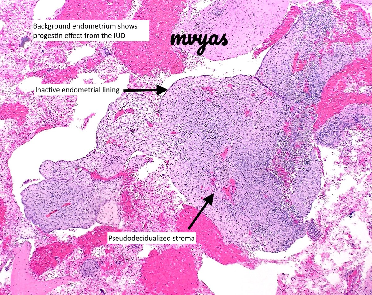 Why PAMRAGs are formed is not entirely known-->may be a result of degradation. Composed of Cu, P, S, Cl and Fe...Cu from IUDs may be a nidus. In pts without IUDs --may originate from lipofuscin PMID 16394276 #gynpath