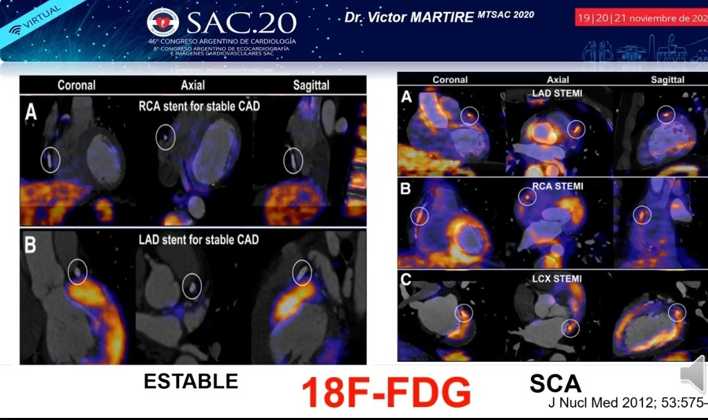 SACnuclear's tweet photo. Congreso #SAC20 ⏰14:05 viernes 20/11 🔊 No te lo pierdas ➡️Mesa: 📌 "Estrategias y metas
de Prevención CV en el paciente Vascular" 📌"¿Es posible identificar placas vulnerables con PET/TC?
🎤 dr Victor Martire y oradores 💯 @CARDIONUCLEAR 💯 @sac_hit @SAC_54
@AacNuclear https://t.co/1JO7rbnES8