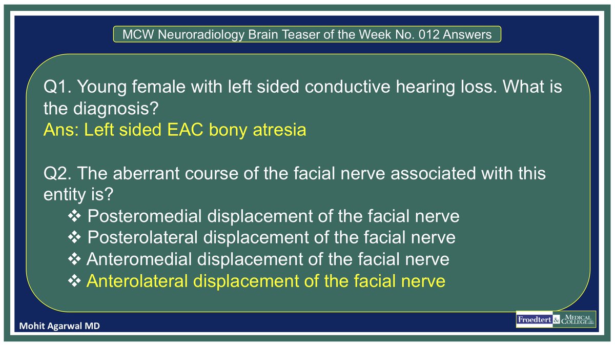 PublishedXPrime's tweet photo. #MCWNeuroradBTW 012 Ans: EAC atresia!

Apologies to the #MCWNeuroradBTW patrons for the two week delay🙏🏻. The quiz will now resume.

#FOAMed #FOAMrad #radres #MedEd #RadEd #NeuroTwitter #MedTwitter @futureradres @Jaswal_Shama @RGovindiah @RobertMurrayMD @drvenkimdrd @SaiVagvalaDO https://t.co/A2CNnmpeQ2