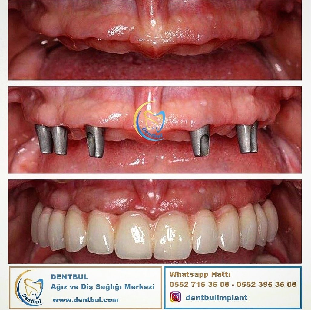 DentbulDis's tweet photo. #implant #diş #dentbul #porselen #yaşam #istanbulimplant #dentbulimplant #zirkonyum #istanbuldiş #lamina #ataköy https://t.co/jnjqgAgmTc