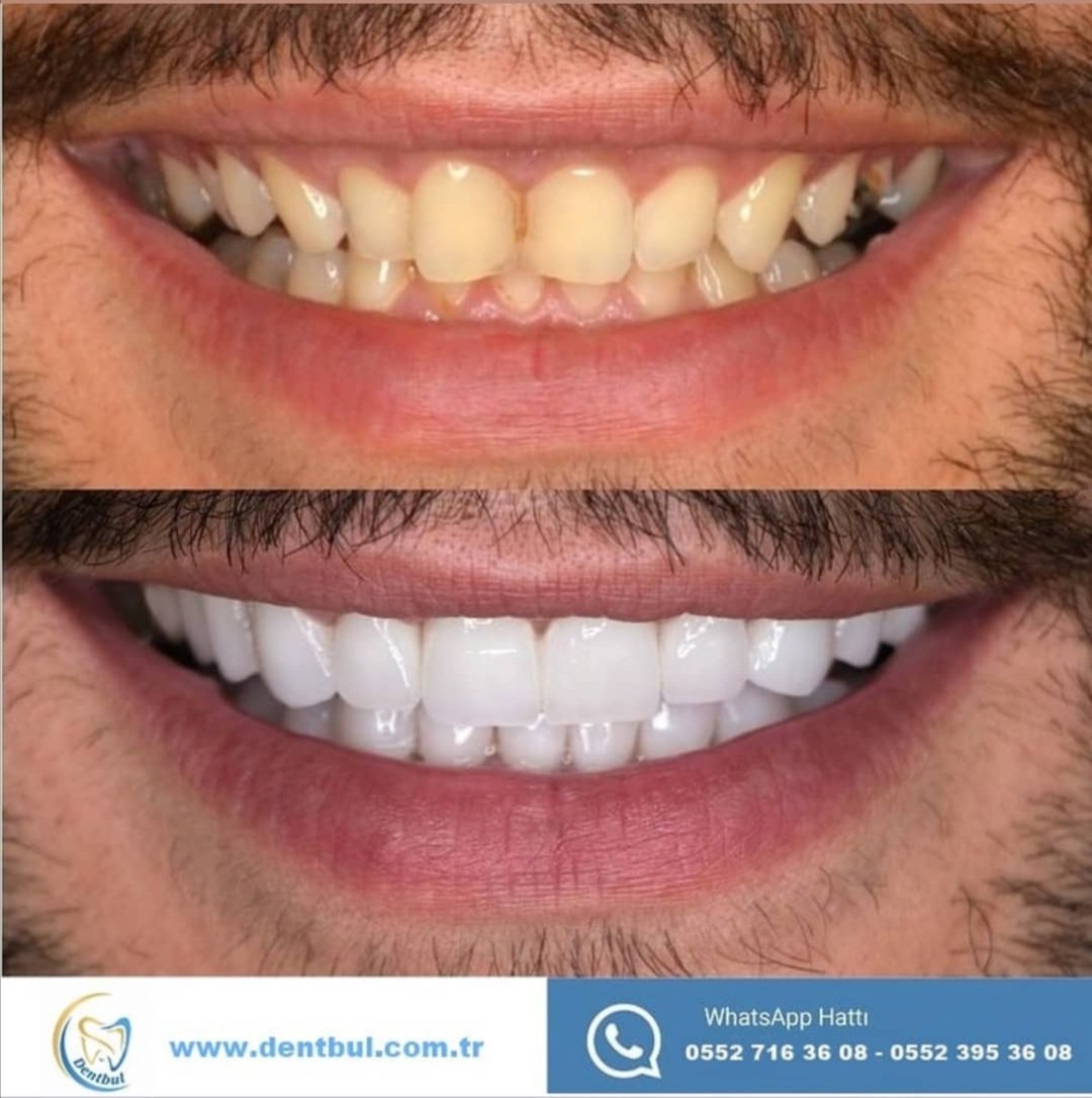 DentbulDis's tweet photo. #implant #diş #dentbul #porselen #yaşam #istanbulimplant #dentbulimplant #zirkonyum #istanbuldiş #lamina #ataköy https://t.co/Nc2kSPByya