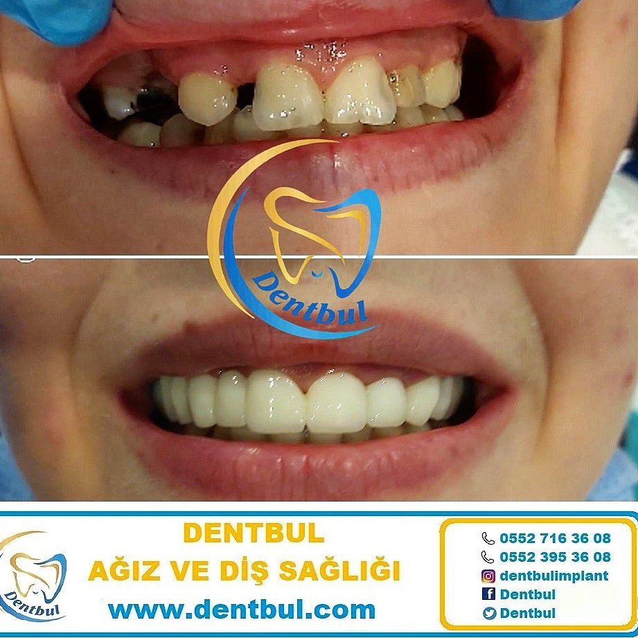 DentbulDis's tweet photo. #implant #diş #dentbul #porselen #yaşam #istanbulimplant #dentbulimplant #zirkonyum #istanbuldiş #lamina #ataköy https://t.co/iOVKIs0gOP