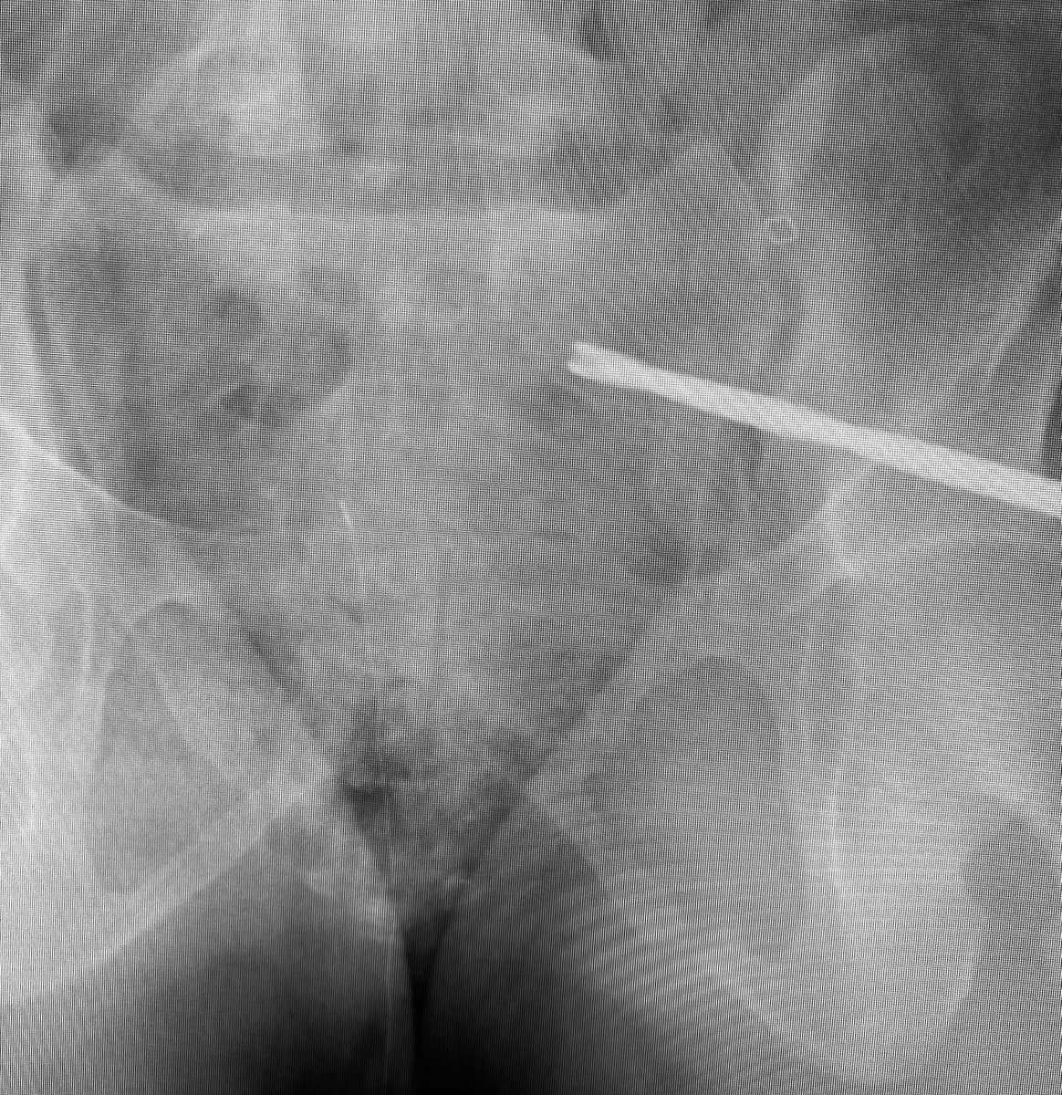 Control your iliosacral screw insertion precision by using an initial K wire to simply identify the optimal insertion site for your intended pathway-insert it 1-2cms then proceed directly to using the cannulated drill - the drill allows early slight corrections without deformity