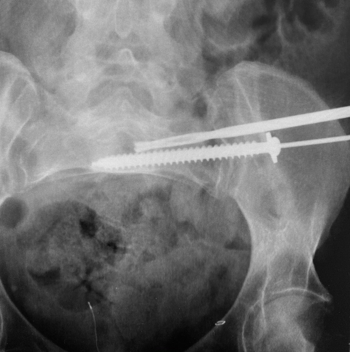 Use the cannulated drill to avoid wayward misdirections from more flexible guide wires