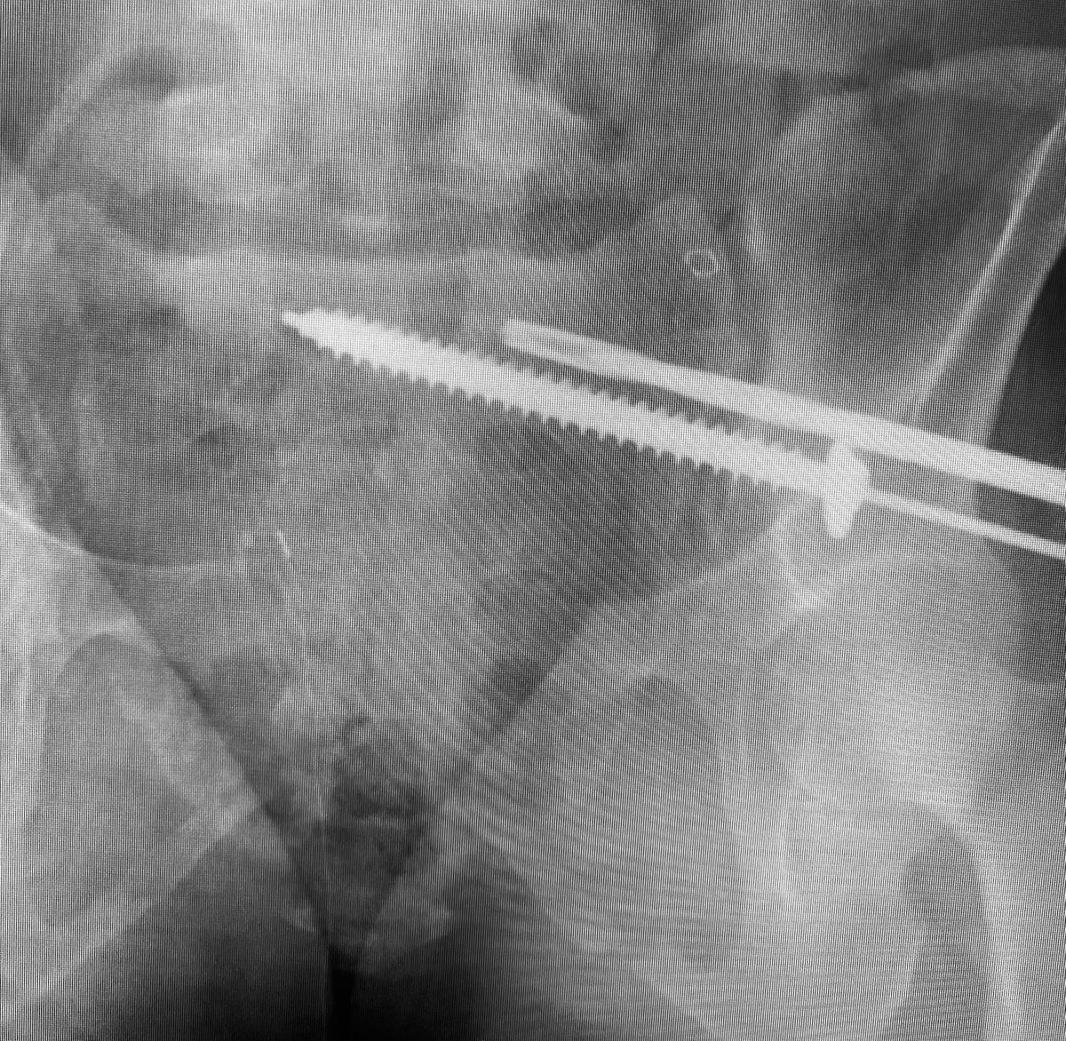 Use the cannulated drill to avoid wayward misdirections from more flexible guide wires