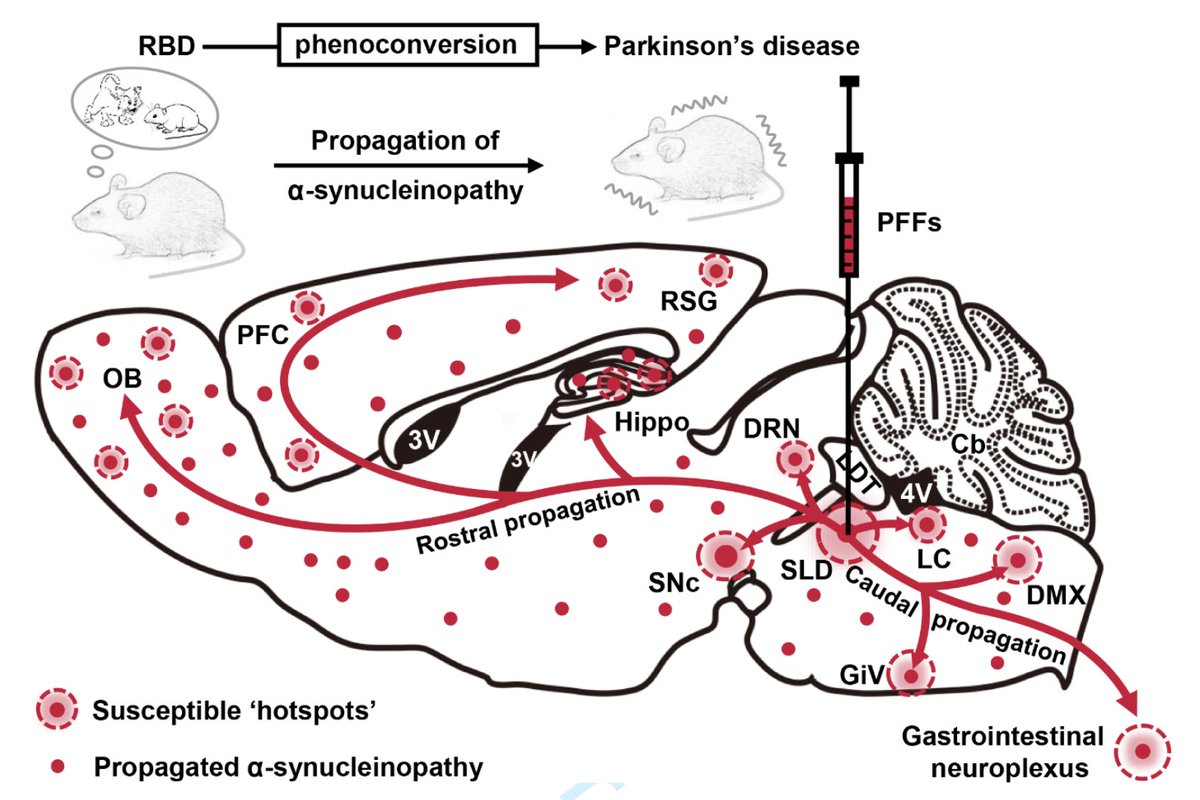 Brain1878's tweet photo. Shen et al. present a novel α-synucleinopathy-based mouse model of REM sleep behaviour disorder, which progresses to develop parkinsonian behavioural and histopathological phenotypes. https://t.co/pPTTrvAGQY https://t.co/Y7vdokF8KX