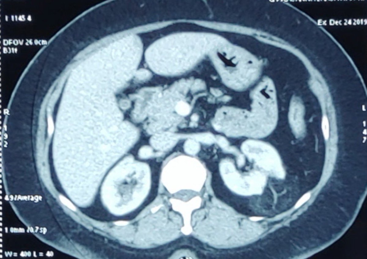 DrVCMohan's tweet photo. #lapPartialNephrectomy in benign tumor is stressful VS malignant. We did Angiomyolipoma, we focused on reducing WIT & completed in 18min WIT.
Mobilising & keeping kidney tumor in ergonomic position with satinsky for right hand suturing is highlighted 👇📹
https://t.co/48fodkEcUv https://t.co/YpGhljT636