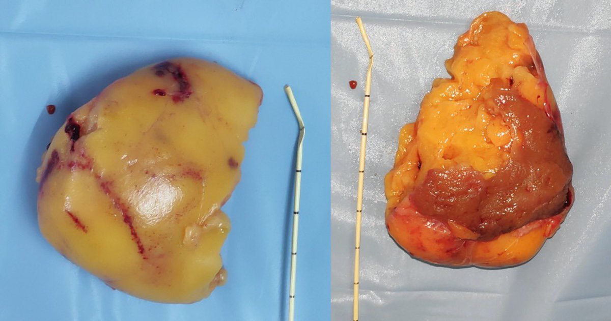 DrVCMohan's tweet photo. #lapPartialNephrectomy in benign tumor is stressful VS malignant. We did Angiomyolipoma, we focused on reducing WIT & completed in 18min WIT.
Mobilising & keeping kidney tumor in ergonomic position with satinsky for right hand suturing is highlighted 👇📹
https://t.co/48fodkEcUv https://t.co/YpGhljT636