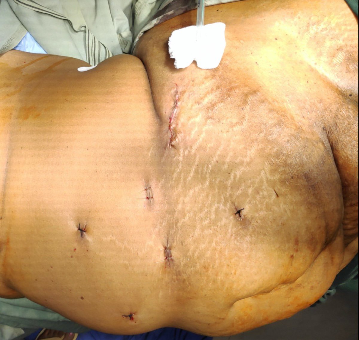 DrVCMohan's tweet photo. #lapPartialNephrectomy in benign tumor is stressful VS malignant. We did Angiomyolipoma, we focused on reducing WIT & completed in 18min WIT.
Mobilising & keeping kidney tumor in ergonomic position with satinsky for right hand suturing is highlighted 👇📹
https://t.co/48fodkEcUv https://t.co/YpGhljT636