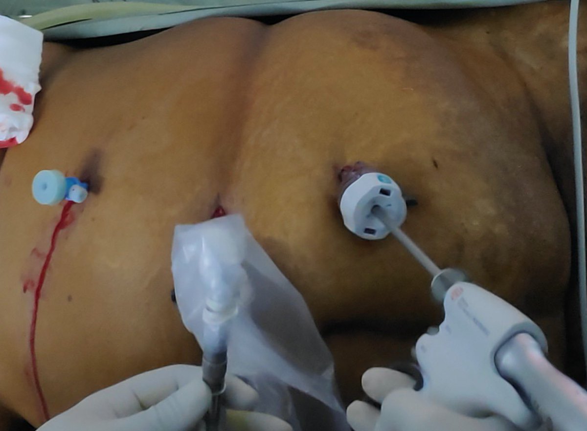 DrVCMohan's tweet photo. #lapPartialNephrectomy in benign tumor is stressful VS malignant. We did Angiomyolipoma, we focused on reducing WIT & completed in 18min WIT.
Mobilising & keeping kidney tumor in ergonomic position with satinsky for right hand suturing is highlighted 👇📹
https://t.co/48fodkEcUv https://t.co/YpGhljT636