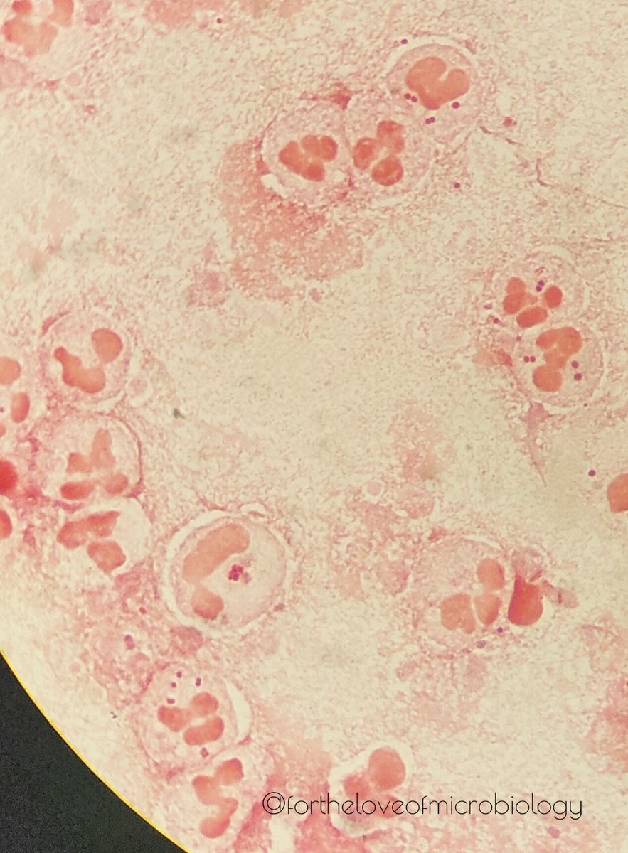 fortheloveofmi2's tweet photo. Gram-negative diplococci seen on a gram-stain of a sputum sample. Note the flattened abutting sides of the diplococci. (Swipe left if you can't find them)
Final culture results: M catarrhalis
 
#fortheloveofmicrobiology #clinicalmicrobiology
#mmidsp #infectiousdiseases https://t.co/i9ynOM5QLA