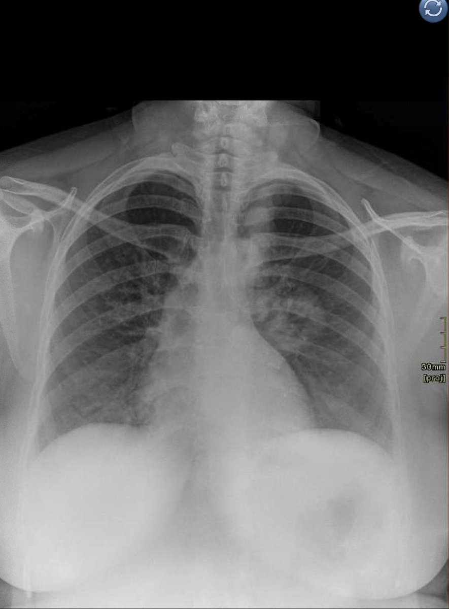 EL_KUT's tweet photo. Two X-rays taken on the same day. Patient completely asymptomatic. @ojayfemi @king_Bash47 @holamiju Can you guess the cause? https://t.co/HYJ8LxUTLL