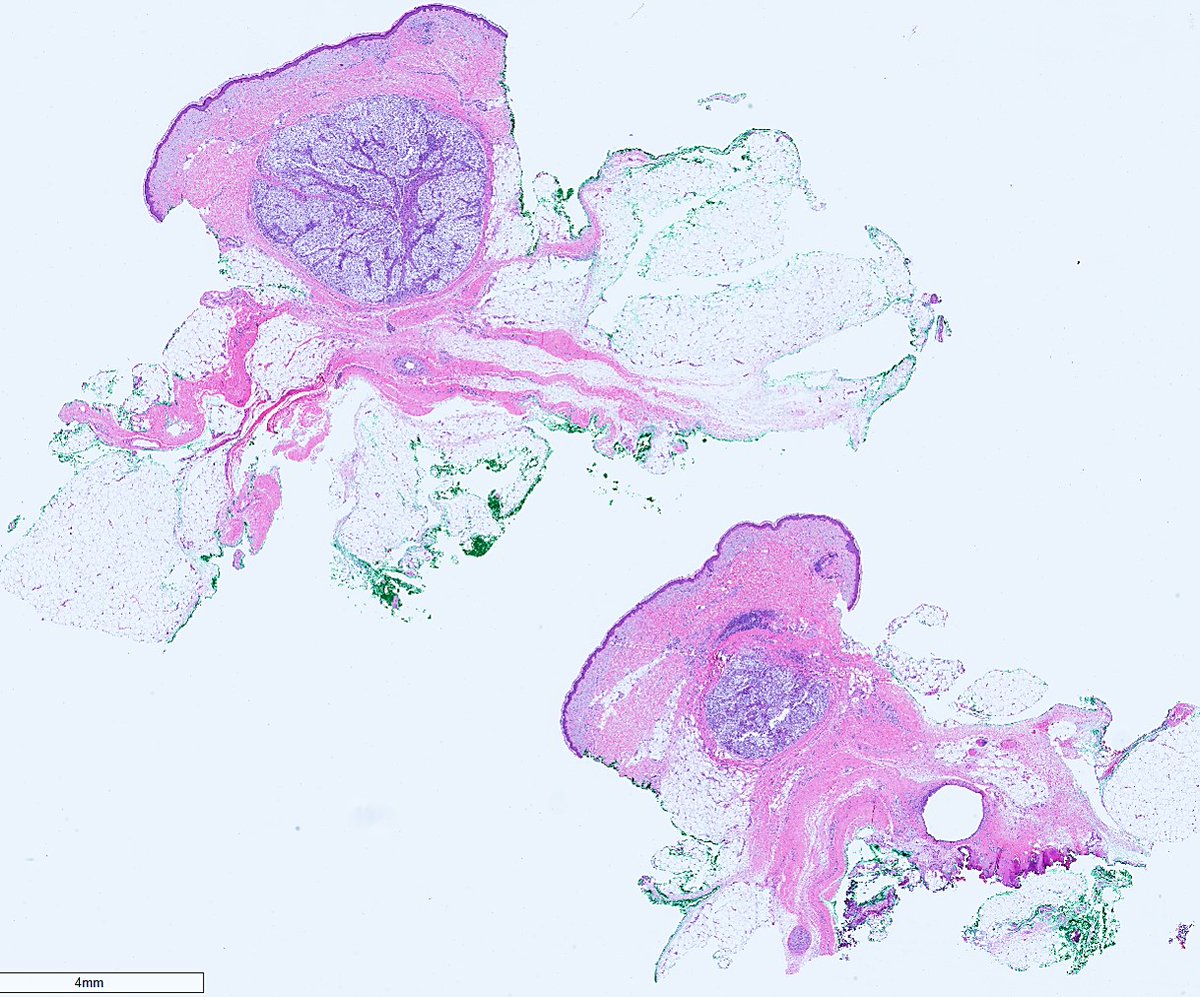 cygupath_md's tweet photo. Skin lesion with the histology seen below, what do you think? #pathology #pathologist #pathtwitter #dermpath #dermatology https://t.co/6H1WloAgFl