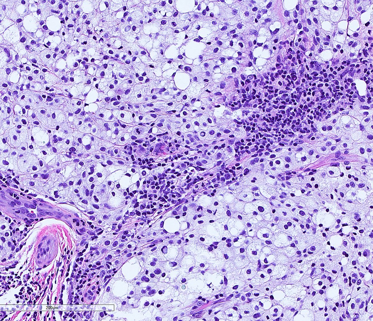 cygupath_md's tweet photo. Skin lesion with the histology seen below, what do you think? #pathology #pathologist #pathtwitter #dermpath #dermatology https://t.co/6H1WloAgFl