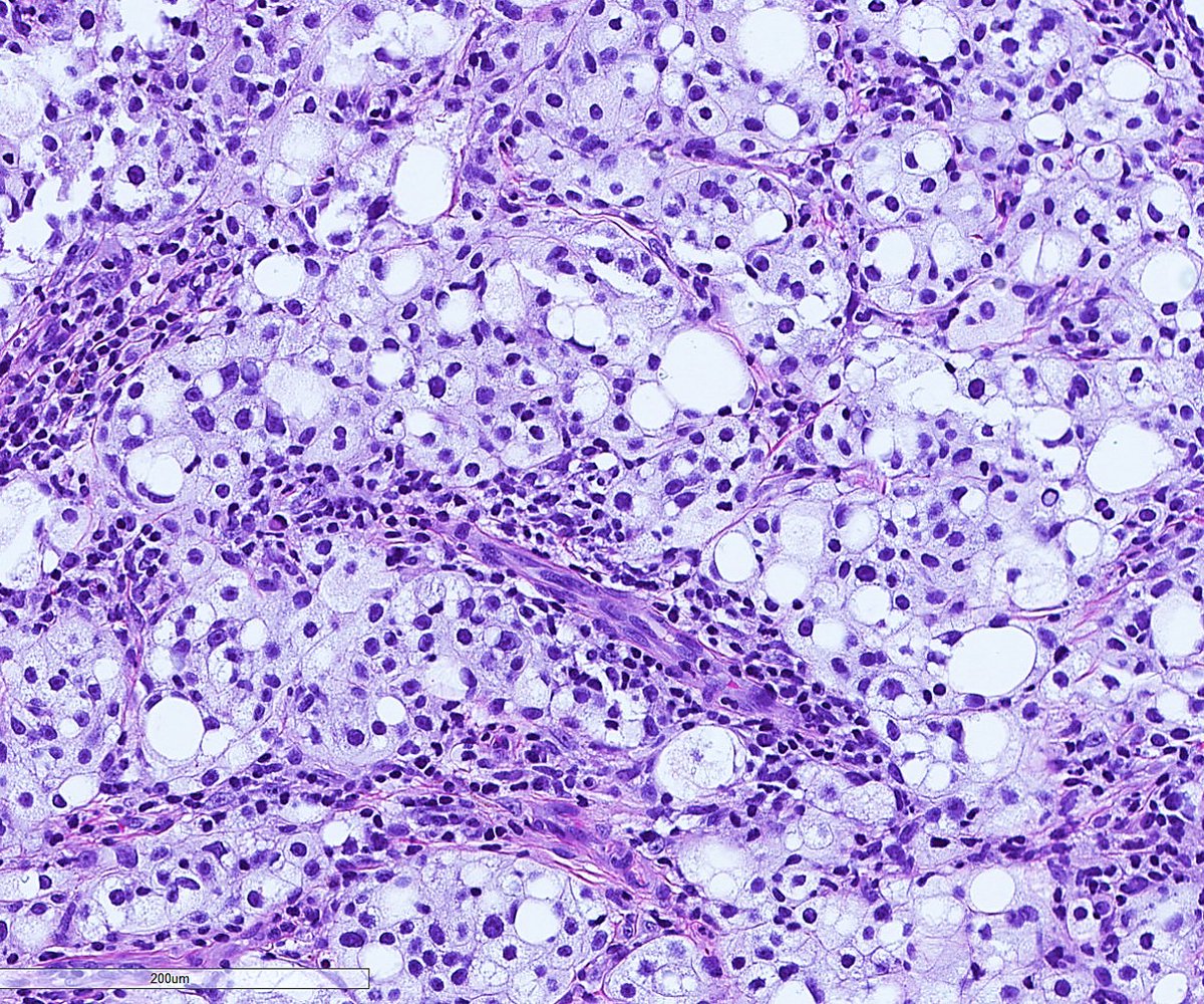 cygupath_md's tweet photo. Skin lesion with the histology seen below, what do you think? #pathology #pathologist #pathtwitter #dermpath #dermatology https://t.co/6H1WloAgFl