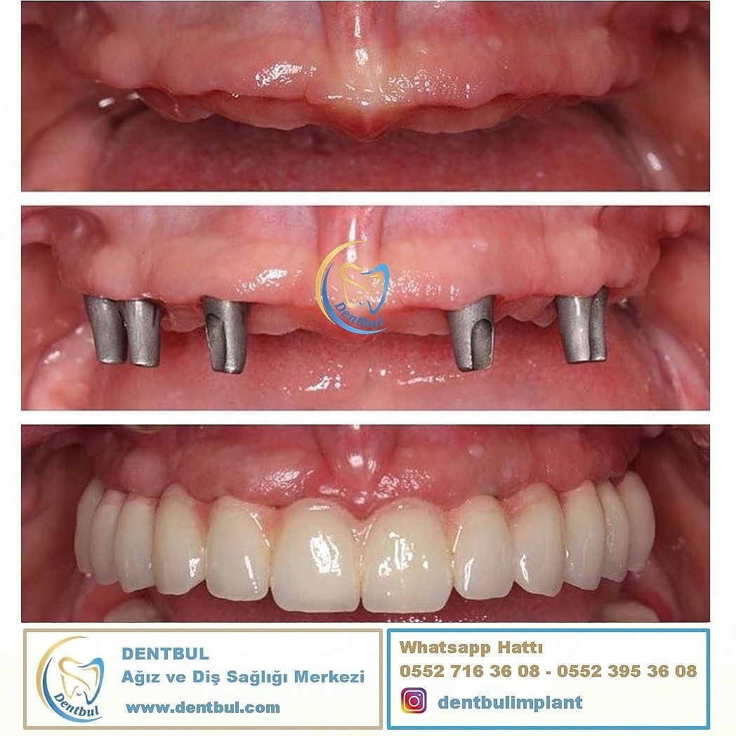 DentbulDis's tweet photo. #implantdiş #sağlıklıdiş https://t.co/V8lNioF3WY