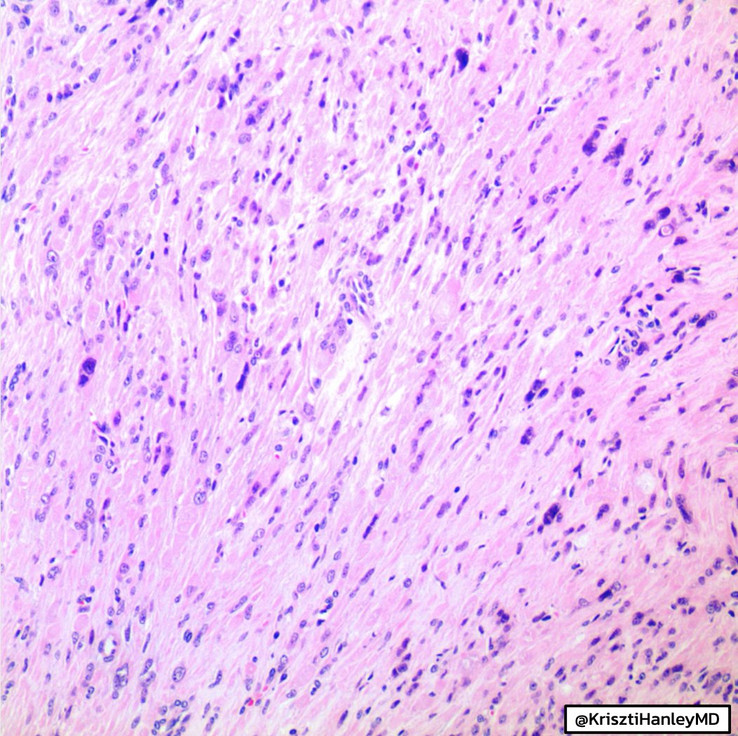 mesothelioma pleural prevention