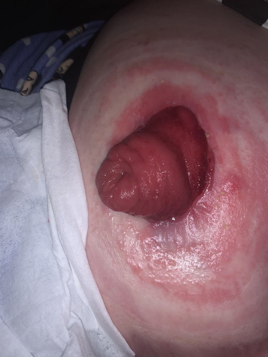 CrohnieClothing's tweet photo. I’m so fed up. I posted this picture last week about having leaks all the time ruining everything I wear/bedding but I can’t get more surgery or I’ll never be able to eat again and have no intestines. This is what I posted vs what I deal with every day. #ASOSGiftMe #ASOSTreatMe https://t.co/b4P0ZfZ2v2
