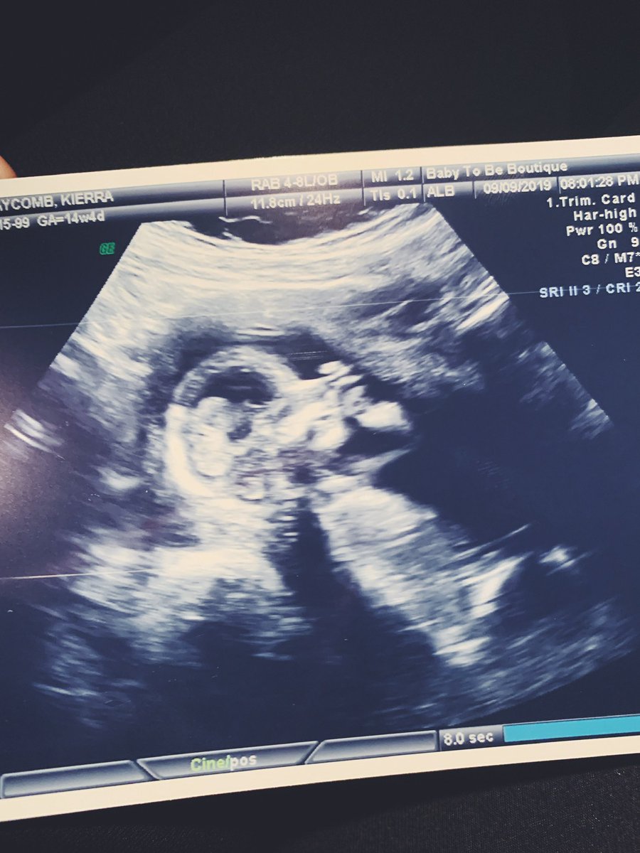 kierraclaycombb's tweet photo. @Bridgetguyer @ash22noel that’s a clump of cells?? *my baby at 14 weeks, which abortions are allowed up to 24 weeks in some states* https://t.co/rD1P8k8y8e