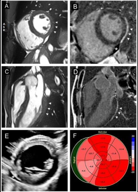 ppsengupta1's tweet image. Multimodality assessment of #COVID related pericardial involvement in student athletes @WVUMedicine @WVUMedSchool @WVUHealth, just published jacc.org/doi/10.1016/j.…