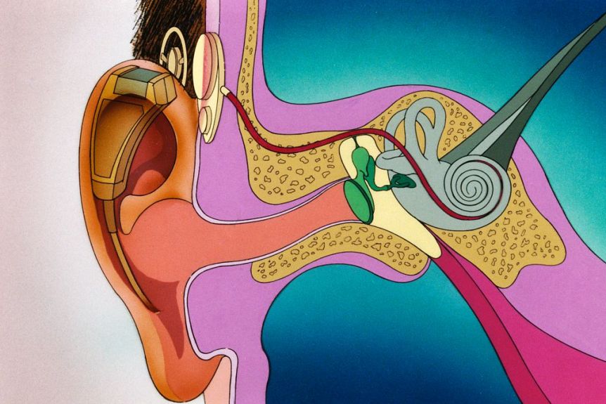 ABCscience's tweet photo. A biomedical engineer at @Sydney_Uni, who has cochlear implants (labour-intensive to fine-tune), has come up with an algorithm that helps tailor implants to an individual's ability to hear different noises.

Via @teegstar &amp; @RadioNational's Health Report.

https://t.co/jE6wLGf5Lq https://t.co/RBcSG6jC9I