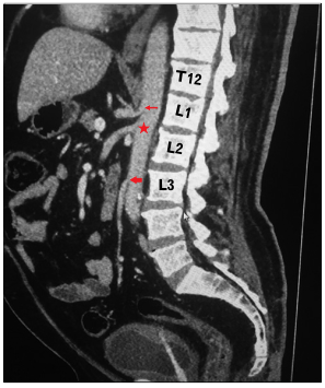 AcbjournalO's tweet photo. Variation in the vertebral levels of the origins of the abdominal aorta branches: a retrospective imaging study

https://t.co/J6ME5dZYqd
Anat Cell Biol 2020; 53(3): 279-283

#대한해부학회 #AnatomyCellBiology 
#ComputedTomographyAngiography #AbdominalAorta #AnatomicVariation https://t.co/e9YhkztrQN
