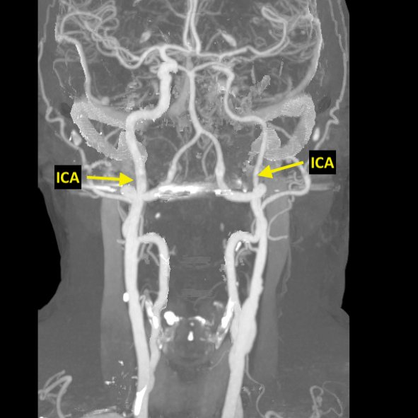 2/ Criteria 1: Reduction of the distal ipsilateral ICA diameter in comparison to the contralateral ICA (as seen on their CTA)