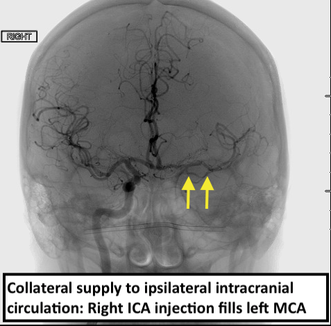 5/Criteria 4: Evidence of collateral supply to the distal intracranial vessels. This is seen on the right ICA injection which also fills the left middle cerebral artery