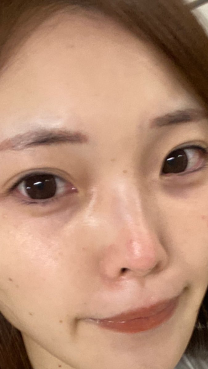 Pipi コレは前日 ノーファンデ すっぴん 素肌 そばかす ピコレーザー フォトフェイシャル