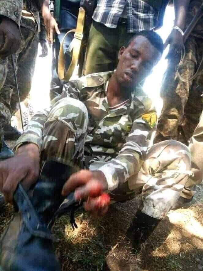 Wounded TPLF Milita receiving medical treatment. Hundreds of TPLF Militia captured in Amhara Region. Majority of them are surrendering with little or no resistance.