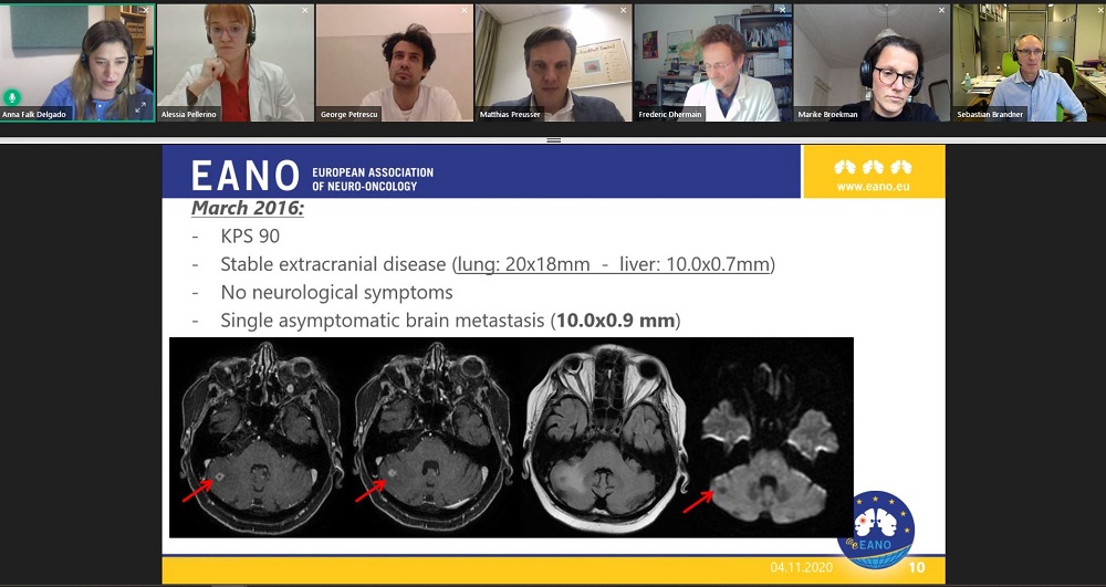 EANOassociation's tweet image. Thank you @AlessiaPelleri1 George Petrescu @mldbneuro (M Broekman), @Seb_Brandner Frederic Dhermain @stemcellab (A Falk Delgado) and @Matthias Preusser for supporting another great #eEANO Tumorboard webinar on #brainmetastases. Missed it 👉watch the video eano.eu/members/login/