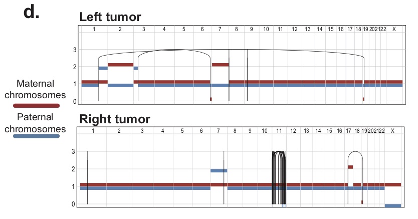 The left and right tumour arise independently, but they undergo remarkably parallel convergent events, mostly shaped by germline predisposition. For example, a second hit in a tumour suppressor by independent LOH events (Chr19), as well as a recurrent trisomy (Chr7). [4/6]