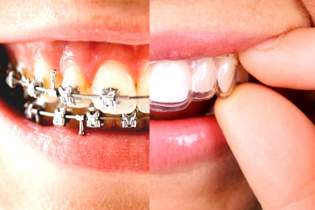 OrchardsScotts's tweet photo. Metal or invisible #braces for straighter #teeth and a prettier #smile? Here’s how to decide: https://t.co/8PfnJlHFd2 #smile #invisalign #beautifulsmile #smilebeautiful #teethwhitening https://t.co/q32KM2tTnv