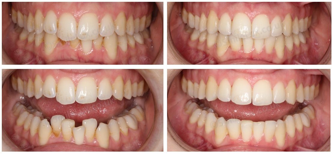 Check out this fantastic Invisalign result! #challengingcase #specialistorthodontist #SmileLux #Invisalign
