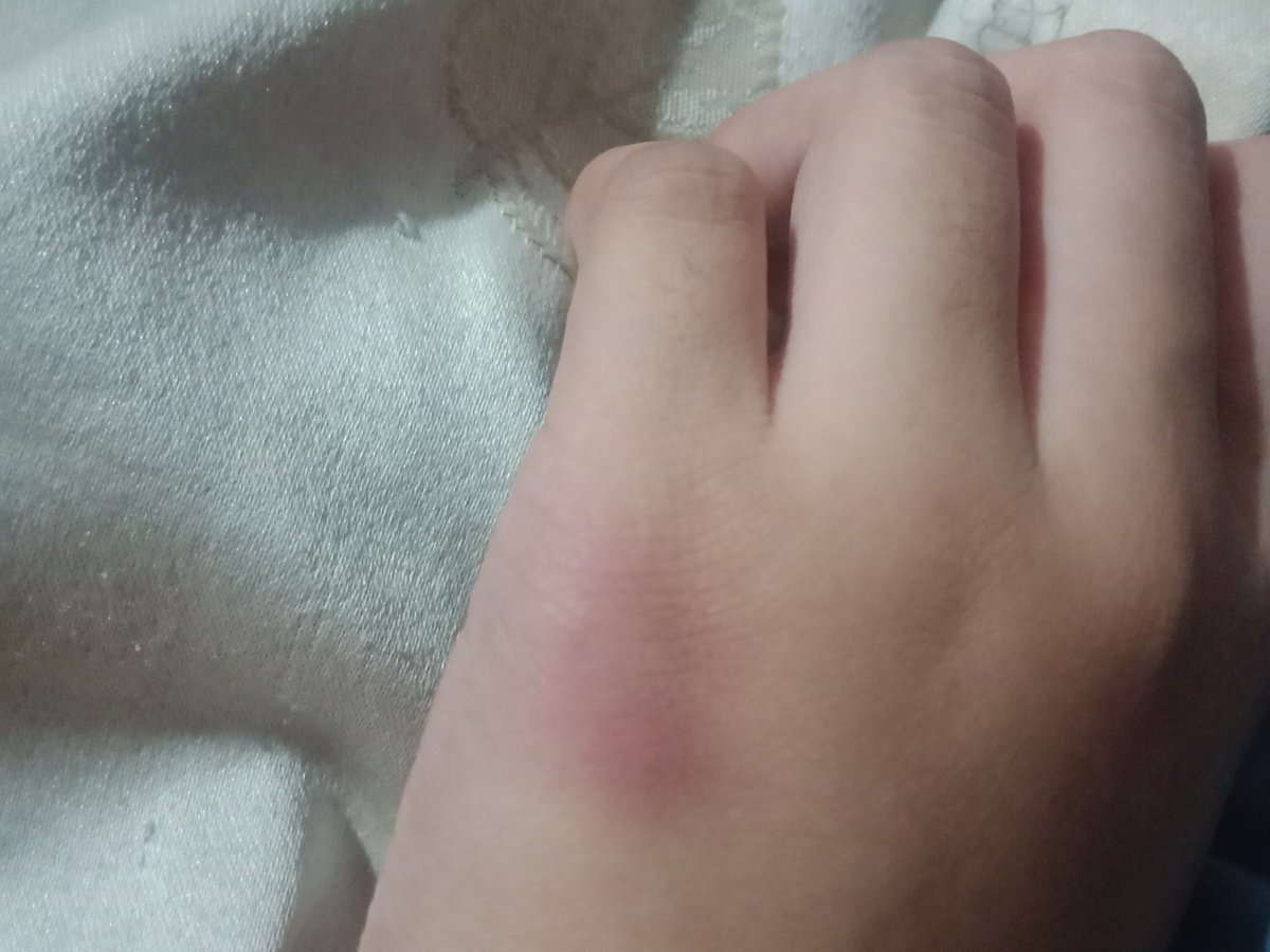 jeywberry's tweet photo. When I'm mad or irritated, the first thing that comes on my mind to let it out is to hit something. And I didn't even realize that I'm already hurting myself 'til the bruises and wounds appear :))
#NotSomethingToBeProudOf https://t.co/SPpPbhN6JL
