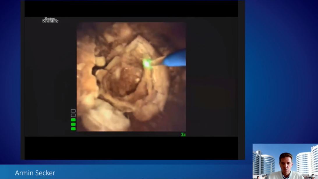 bsc_urology's tweet photo. Happening now at T&amp;T! Dr. Armin Secker (@SeckerArmin) showing RIRS with LithoVue 
To learn more : https://t.co/HN1xFiva2F https://t.co/SDjEECEVvY