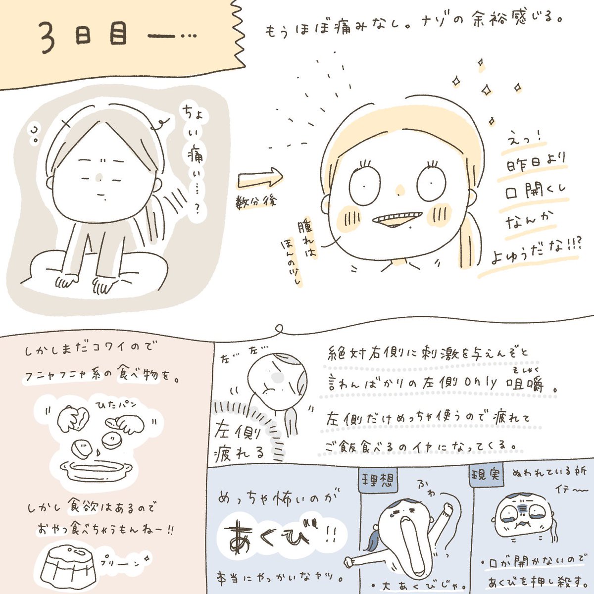 ? 親知らず抜歯レポ ② ?

2〜4日目の様子です。右上抜いたんだけど、左ばかりで噛むもんだから左のほっぺムキムキになってまうぞ?と不安になりました。 