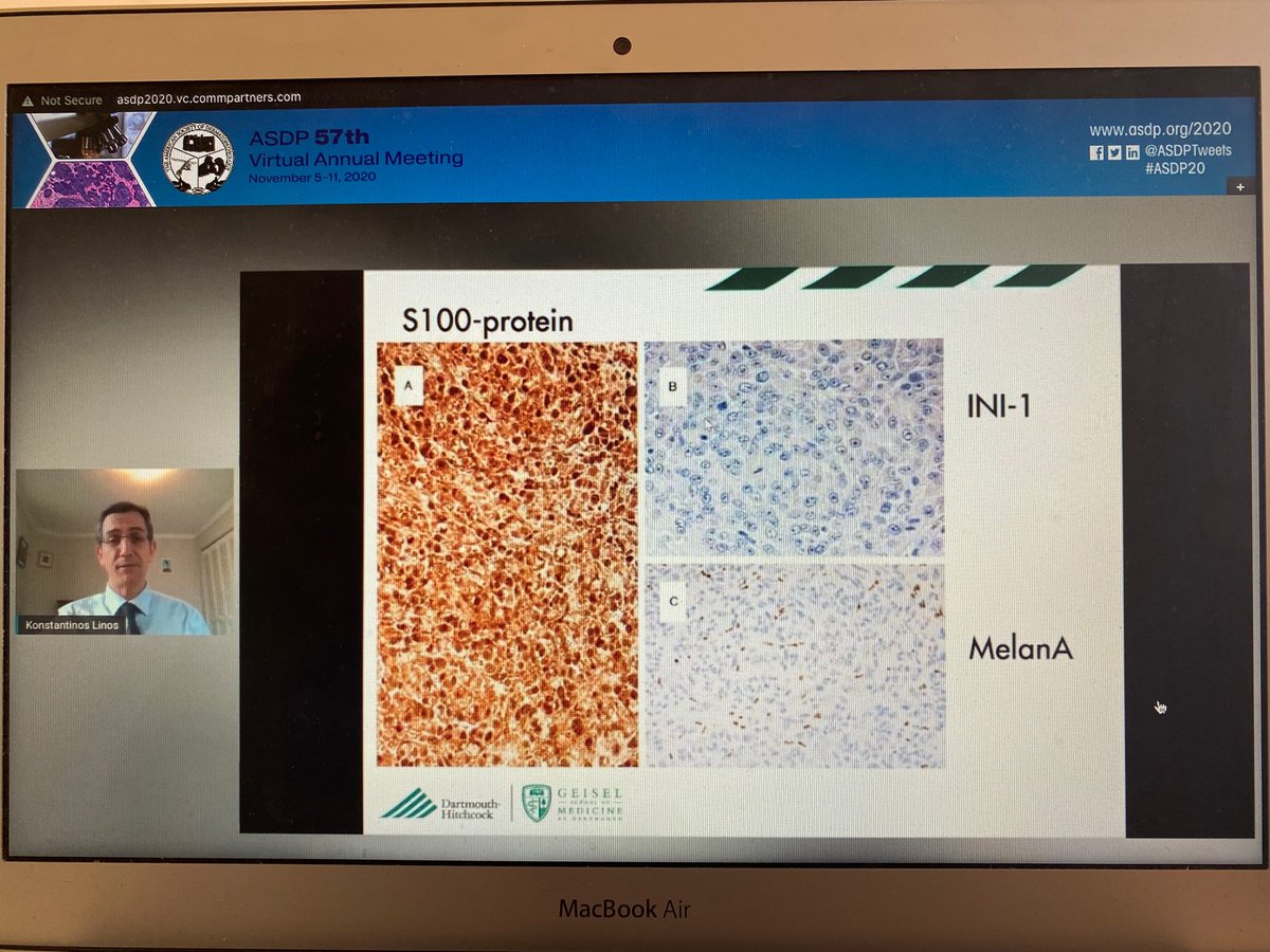 AAlhatem_MD's tweet image. If your DDx Epithelial MPNST and Melanoma, INI is lost in MPNST but not in Melanoma @KonstantinosLin #ASDP20 @ASDPTweets